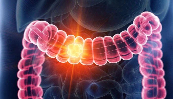 آنتوں کا کینسر 50 سال سے کم عمر افراد میں کینسر سے اموات کی بڑی وجہ 1 1566730 052044 updates